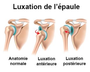 Schéma Luxation épaule